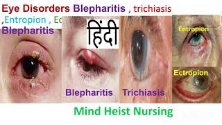 Eye DisordersBlepharitis  trichiasis Entropion  Ectropion Medical Surgical II 3rd Bsc Nursing [upl. by Nnalyrehs309]