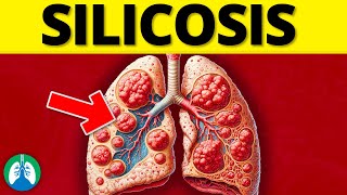 What is Silicosis EXPLAINED [upl. by Elleinaj]