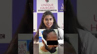 E3  6 months hair Transplant Result [upl. by Natascha]