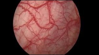 Cystoscopy with Hydrodistention for Interstitial Cystitis patients [upl. by Euqinomad]