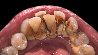 Crowding Teeth Will Increase Tartar Buildup  Scaling [upl. by Rollins189]