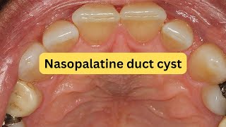 What is nasopalatine duct cyst EASY [upl. by Ennyrb]