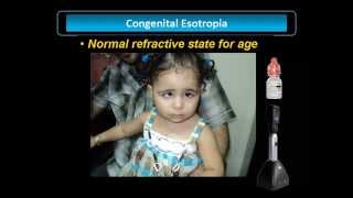 Congenital Esotropia [upl. by Rudiger]