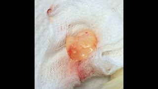 Cyst explodes [upl. by Adest]