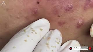 Big Cystic Acne Blackheads Extraction Blackheads amp Milia Whiteheads Removal Pimple Popping [upl. by Are]