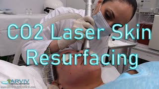 7Day Journey My CO2 Laser Skin Resurfacing Experience – Before and after chris link [upl. by Cline664]