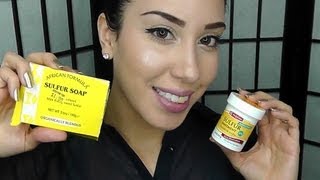 Clear Acne FAST Using Sulfur  ♥ [upl. by Philomena]