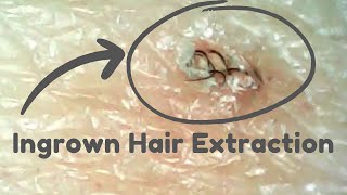 Ingrown Hair Extraction Unraveling the Wildest Twirliest Hairs ASMR Marathon [upl. by Ailasor]