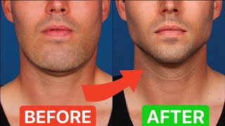 How To ACTUALLY Lose Face Fat in 5 EASY STEPS [upl. by Pollie]