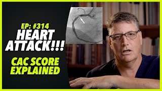 Ep314 HEART ATTACK – CAC SCORE EXPLAINED [upl. by Atla]