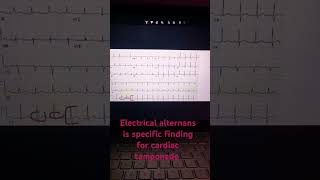 Electrical alternans in ecg [upl. by Aicirtam]