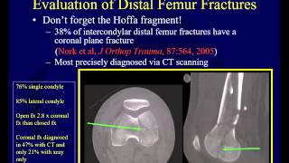 Distal femur fractures  Assessment and preop planning OTA lecture series III l5a [upl. by Sairtemed]