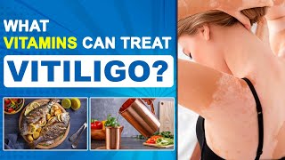 Essential Vitamins For Vitiligo Patient  How To Stop Spreading Vitiligo  Dr Health [upl. by Bent397]