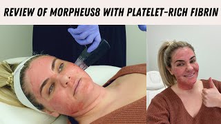 Morpheus8 Treatment  PRF Everything you need to know [upl. by Asuncion235]