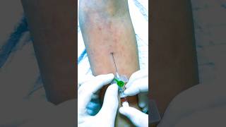 IV Cannulation techniques subscribe cannula cannulainsertion shortsindia [upl. by Niko]