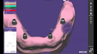 Exocad Exoplan 3Shape InLab Cerec SUM3D Icamv5 Ceramill Maestro3D [upl. by Kaspar]