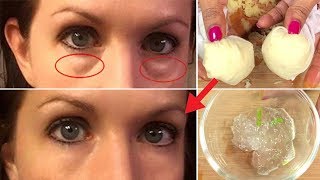 In 3 days Remove Under Eye Bags Completely  Remove Dark Circle Wrinkles Puffy Eyes [upl. by Draillih227]