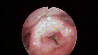 Laryngopharyngeal Reflux and Anterior Glottic Pinch [upl. by Aeslahc]