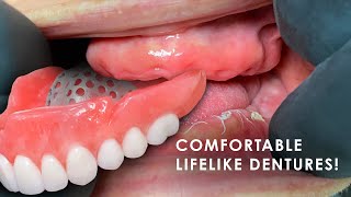 How to Create Comfortable Lifelike Dentures [upl. by Adnelg]