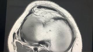 Case of the day  Medial patellar Plica Syndrome  multipartite patella dorsal patellar defect [upl. by Eselahs]