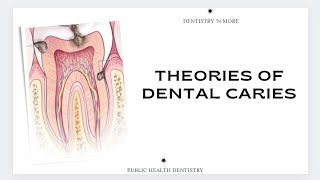 THEORIES OF DENTAL CARIES [upl. by Gereld]