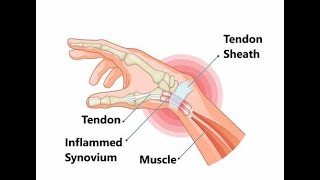 Tenosynovial Crepitus  Definition Meaning Causes Symptoms Treatment [upl. by Roos]