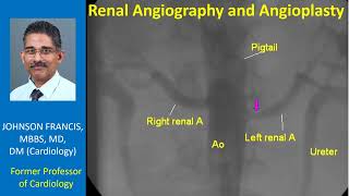 Renal Angiography and Angioplasty [upl. by Sahcnip679]