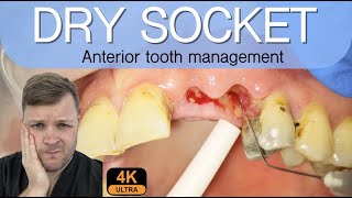 Alveolar Osteitis Management  4K Resolution [upl. by Ailefo]