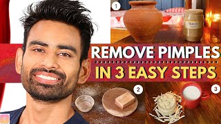 ULTIMATE Ayurvedic Routine to Get Rid of Pimples amp Acne Permanently Men amp Women [upl. by Anasor]