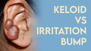 Keloid or Irritation Bump How to fix quotpiercing bumpsquot [upl. by Radmen]