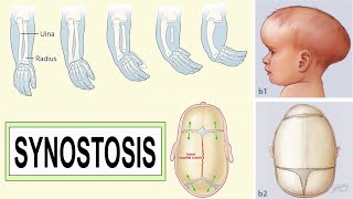 synostosis [upl. by Iew638]