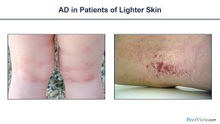 Pediatric Atopic Dermatitis Assessing Disease Severity and Implementing Targeted Treatment [upl. by Naitsirhk]