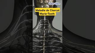 Maladie de CharcotMarieTooth marietooth maladiedecharcot charcotmarietooth neurodegenerative [upl. by Clarine]