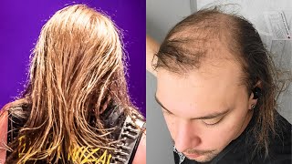 FRONTMAN TELLS ALL On Losing His Hair BALDING [upl. by Mazur]