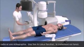 Lithotripsie extra corporelle  Extracorporeal Shock Wave Lithotripsy Montpellier [upl. by Felecia]