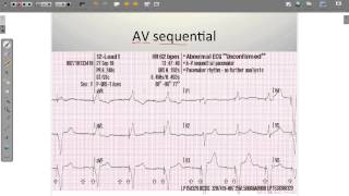 ECG Paced Rhythms [upl. by Solley]