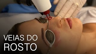 Tratamento para Veias do Rosto [upl. by Akimit]