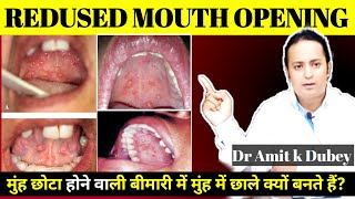 सिर्फ ये गलती कभी नहीं करनी चहिए । limited mouth opening । Sub Mucous fibrosis ।OSMF ।dramitkdubey [upl. by Eedyah]