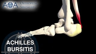 AOA Orthopedic Specialists  Achilles Bursitis [upl. by Lissy]