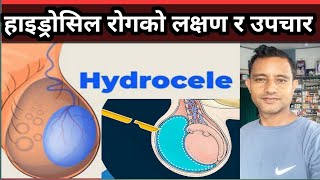 Hydrocele details in Nepali हाइड्रोसिल कसरी हुन्छ यसको लक्षण तथा औषधि उपचार कसरी गर्ने [upl. by Acired158]