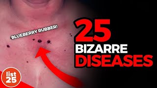 25 BIZARRE DISEASES Science Cant solve [upl. by Yelyak]