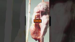 Etapa de la enfermedad renal cronica V [upl. by Lipson]