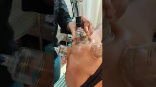 Cupping therapy bestphysiotherapy physiotherapyandrehabilitation [upl. by Rola]