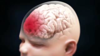 Shaken Baby Syndrome Brain Injury [upl. by Id]