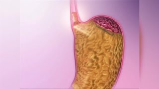 Acid Reflux Natural Remedies [upl. by Whit402]