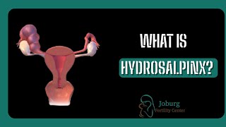 WHAT IS HYDROSALPINX [upl. by Eirac930]