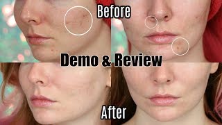 Trophy Skin MicrodermMD REVIEW amp DEMO  Before and After [upl. by Letnuahc]