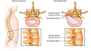 Back pain kamar Dard L4 L5 L5 S1 disc mein problem thi vah Dr AP GAUTAM physiotherapy se thik kardi [upl. by Dietz]