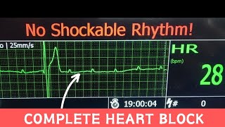 Third Degree AV Block  Complete Heart Block on Hospital Monitor cardiology [upl. by Ellata162]