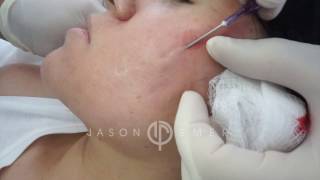 Subcision for Acne Scars  Acne Scar Treatment  Cheek Acne Scar Removal  Dr Jason Emer [upl. by Nednerb404]